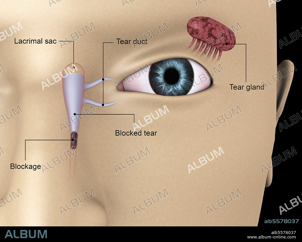 Diagram illustrating blocked tear ducts in the human eye.