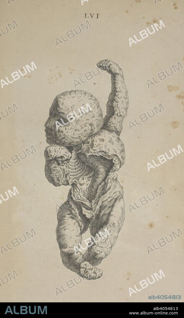WILLIAM CHESELDEN. A lithopedion, also known as "stone baby."   Inscription reads: "A bony chalk foetus which was said to have lain in utero twenty-six yeas: Communicated to me by Monsieur Arneau owner of the french anatomy waxwork.". Osteographia, or the Anatomy of the bones. London, 1733. Source: 458.g.1 plate LVI.