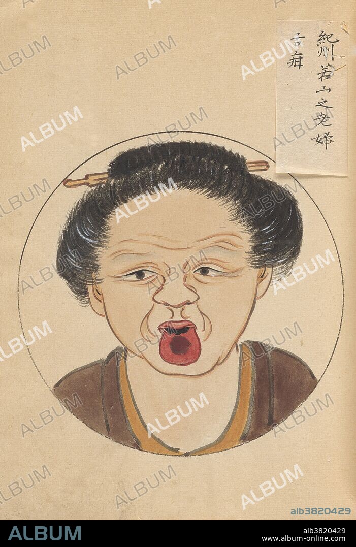 Tongue Cancer, ""A Surgical Casebook""