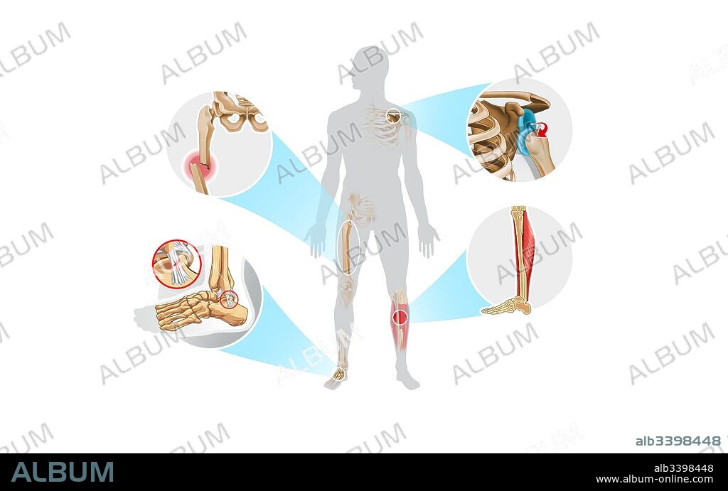 Lesiones del aparato locomotor.