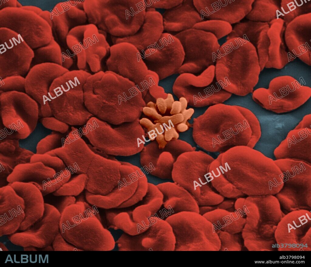 SEM of red blood cells, partially frozen-hydrated from capillary smear, and echinocyte showing projections. Echinocyte, in human biology and medicine, refers to a form of red blood cell that has an abnormal cell membrane characterized by many small, evenly spaced thorny projections. A more common term for these cells is burr cells. Red blood cells (RBCs), also called erythrocytes, are the most common type of blood cell and the vertebrate organism's principal means of delivering oxygen (O2) to the body tissues - via blood flow through the circulatory system. RBCs take up oxygen in the lungs or gills and release it into tissues while squeezing through the body's capillaries. Magnification @ 5250, 8x10 print. This image has been color enhanced.