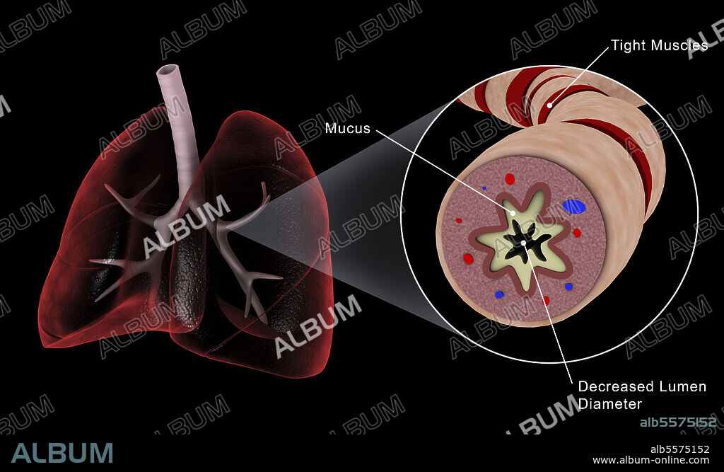 Medical illustration of an asthmatic bronchiole in the human lungs.