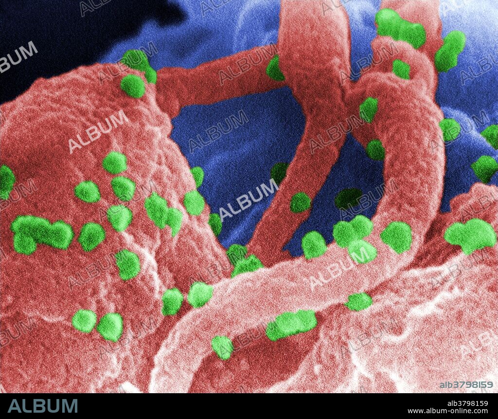 Scanning electron micrograph revealed the presence of the human immunodeficiency virus (HIV-1), (spherical in appearance), which had been co-cultivated with human lymphocytes. Note the lymphocyte in the lower left, and some of its extended pseudopodia. HIV-1 virions can be seen on the surface of this lymphocyte. A retrovirus, the Human Immunodeficiency Virus (HIV) was identified in 1983 as the pathogen responsible for the Acquired Immunodeficiency Syndrome (AIDS). AIDS is characterized by changes in the population of T-cell lymphocytes that play a key role in the immune defense system. In the infected individual, the virus causes a depletion of T-cells, called T-helper cells, which leaves these patients susceptible to opportunistic infections, and certain malignancies.