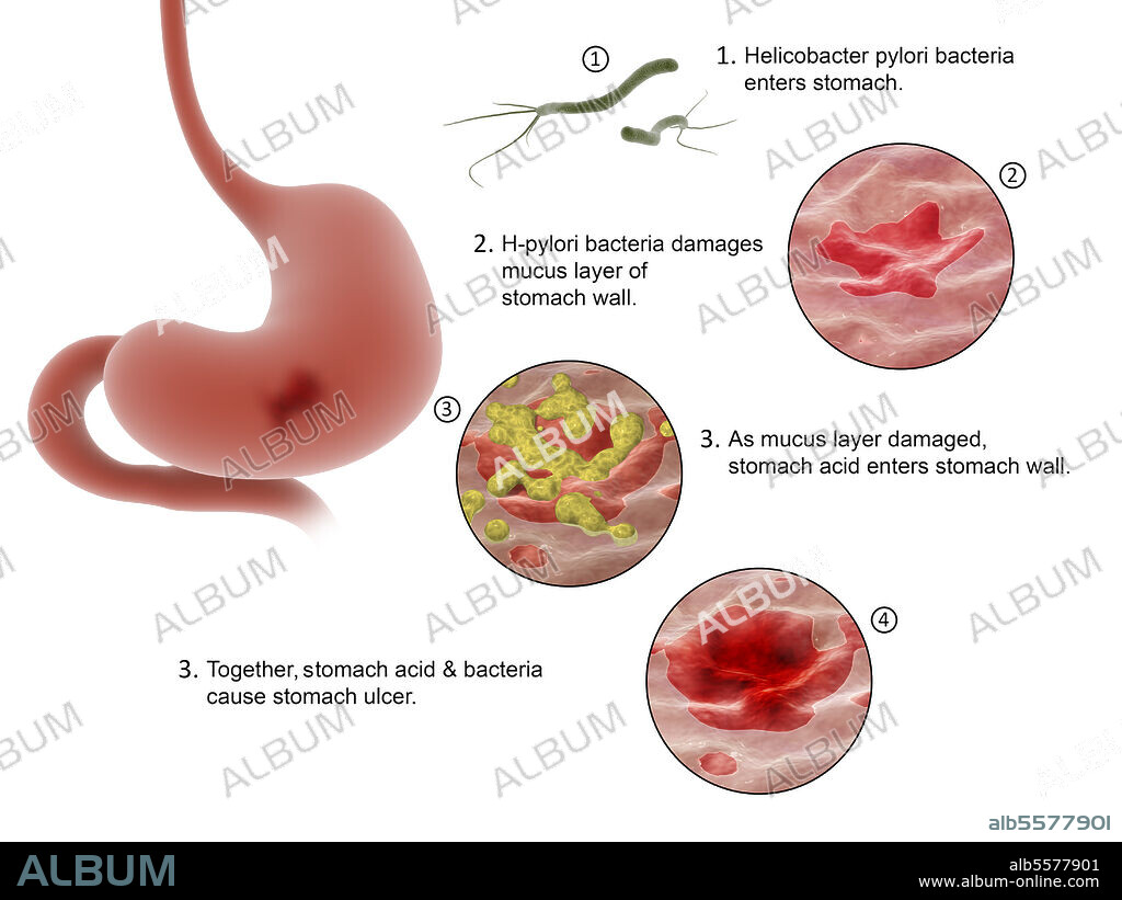 Medical diagram showing the process of Helicobacter pylori bacteria entering the stomach and causing ulcers.