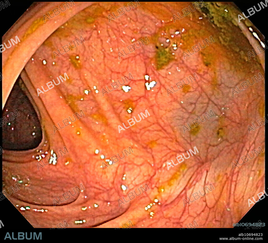 Endoscopic view of Normal Colon, Hepatic Flexure
