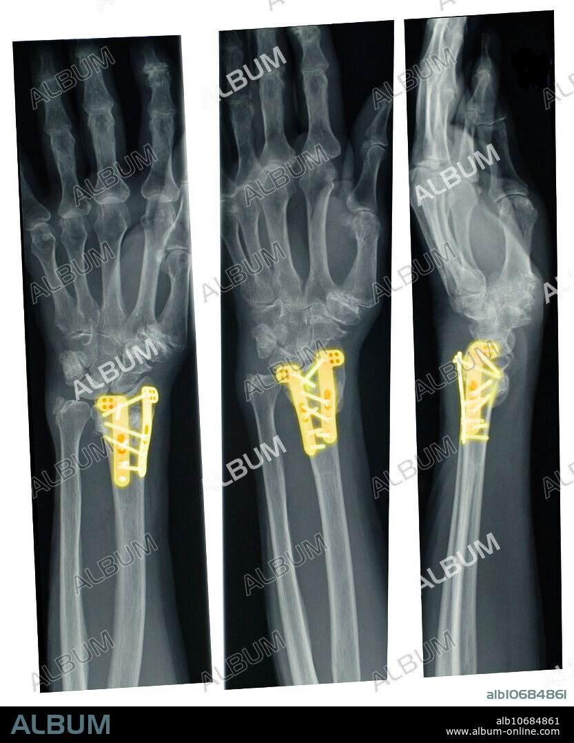 Forearm and hand X-Ray of an ORIF procedure performed on a 76 year old female. ORIF stands for ''Open Reduction Internal Fixation.'' Open Reduction denotes open surgery to set the bones in question, and Internal Fixation denotes the fixation of plates and/or screws to help healing.