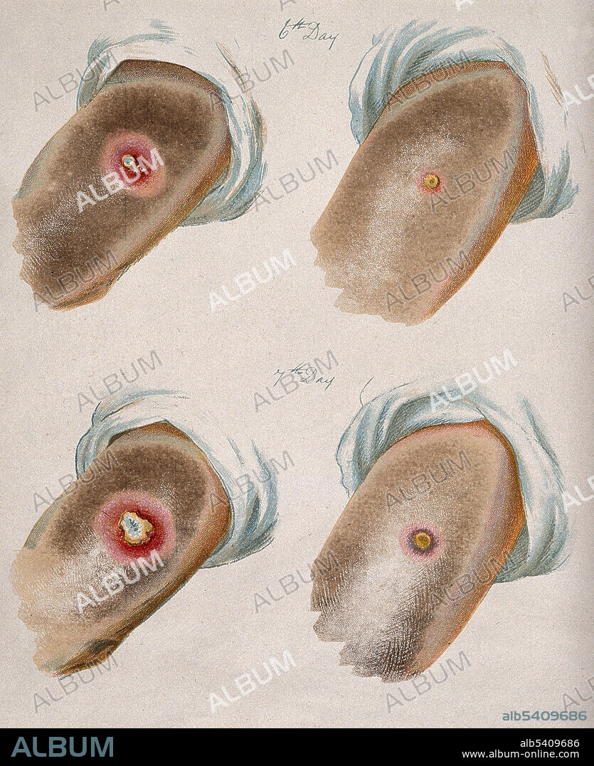 A comparison between smallpox and cowpox pustules on the 6th and 7th day of the disease. Cowpox (orthopoxvirus family) is an infectious disease caused by the cowpox virus. The virus is zoonotic, meaning that it is transferable between species, such as from animal to human. The transferral of the disease was first observed in dairymaids who touched the udders of infected cows and consequently developed the signature pustules on their hands. Cowpox is similar to, but much milder than, the highly contagious and often deadly smallpox disease. Its close resemblance to the mild form of smallpox and the observation that dairy farmers were immune from smallpox inspired the first smallpox vaccine, created and administered by English physician Edward Jenner. Once vaccinated, a patient develops antibodies that make them immune to cowpox, but they also develop immunity to the smallpox virus, or Variola virus. Chromolithograph, after George Kirtland, 1896.