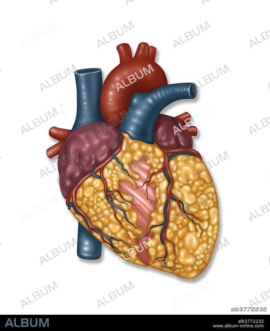 Illustration showing an unhealthy heart surrounded by fat.