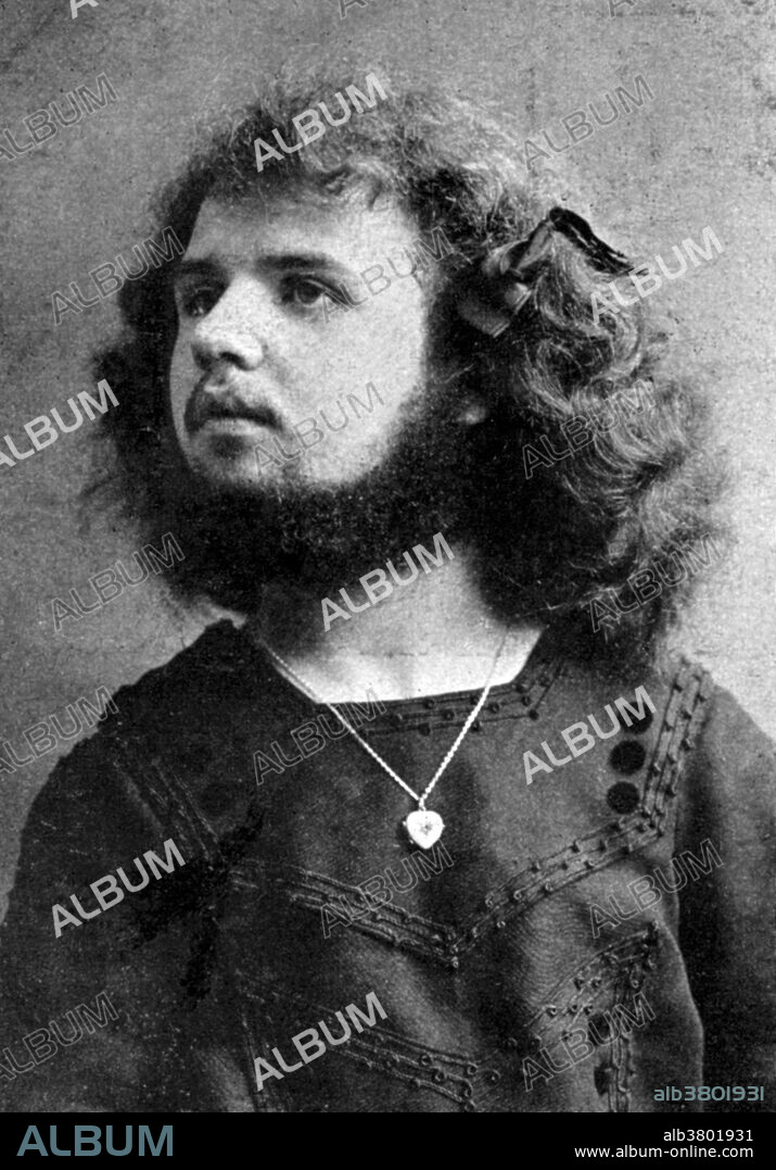 Postcard showing bearded lady, Gruss von Hede. It was posted in Munich in October 1916. The card would probably have been sold as a souvenir at places where she was exhibited as part of a circus, freak or variety show. A relatively small number of women are able to grow enough facial hair to have a distinct beard. In some cases, female beard growth is the result of a hormonal imbalance (usually androgen excess), or a rare genetic disorder known as hypertrichosis. Sometimes it is caused by use of anabolic steroids. Cultural pressure leads most to remove it, as it may be viewed as a social stigma. Bearded ladies were, and still are, a staple of a carnival sideshow. Von is a term used in German language surnames either as a nobiliary particle indicating a noble patrilineality or as a simple preposition that approximately means of or from in the case of commoners.