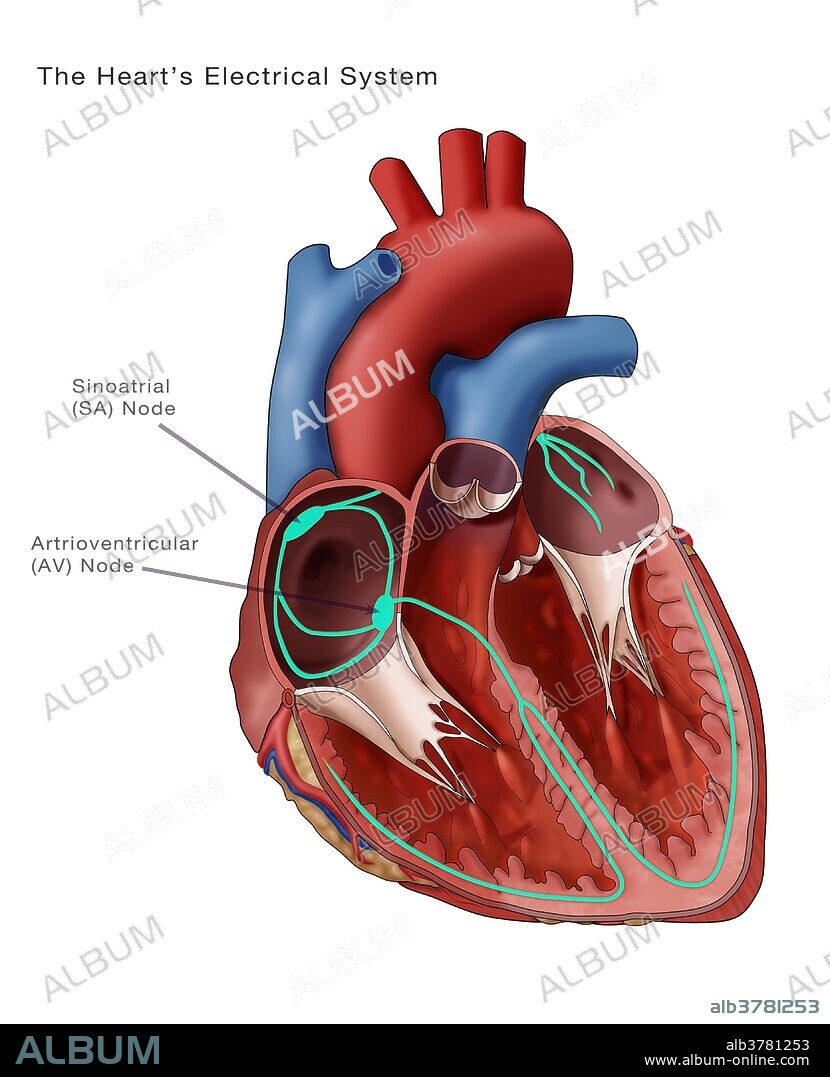 Illustration depicting the heart's electrical system. Annotated are the Sinoatrial node and the atrioventricular node. The sinoatrial (SA) node (thick green oval upper left) consists of self-excitatory muscle cells that contract rhythmically at around 70 beats per minute. Following each contraction, an impulse spreads through the heart's upper chambers (atria, upper frame) to the atrioventricular (AV) node (thick green oval opposite SA node). Contraction of the atria causes blood to move into the lower chambers (ventricles, lower frame).