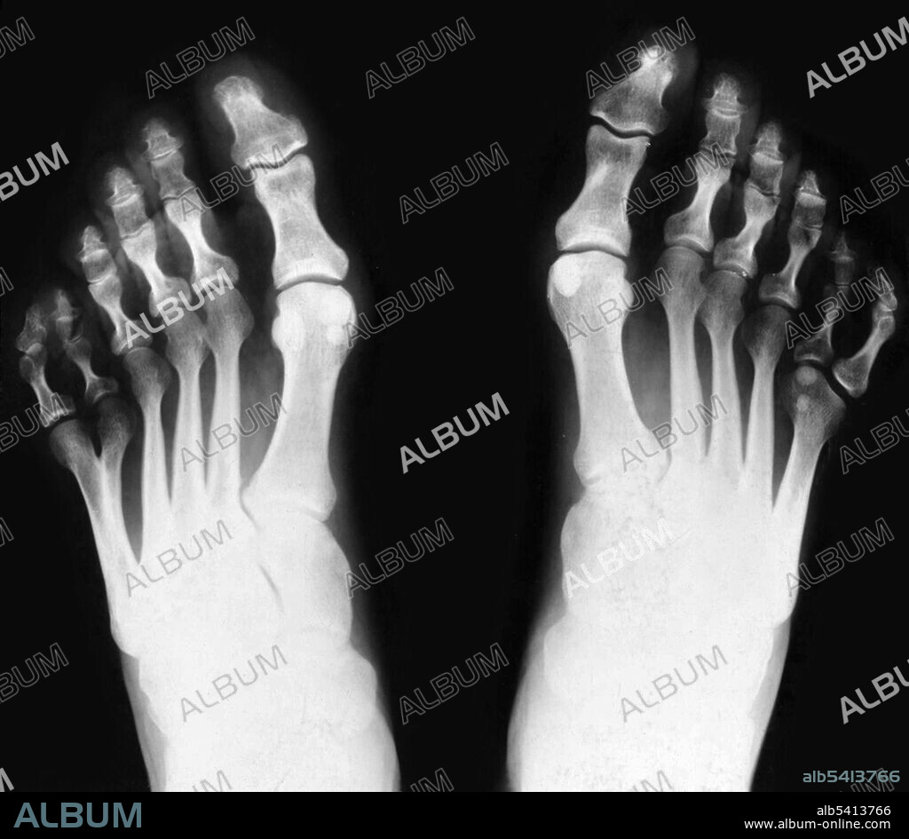 X-ray of feet, showing postaxial polydactyly. Polydactylism is the congenital abnormality of having extraneous fingers or toes. As visible above, this individual had six toes on both feet. This is an example of postaxial polydactyly, because the extra digit occurs on the pinky side of the foot.