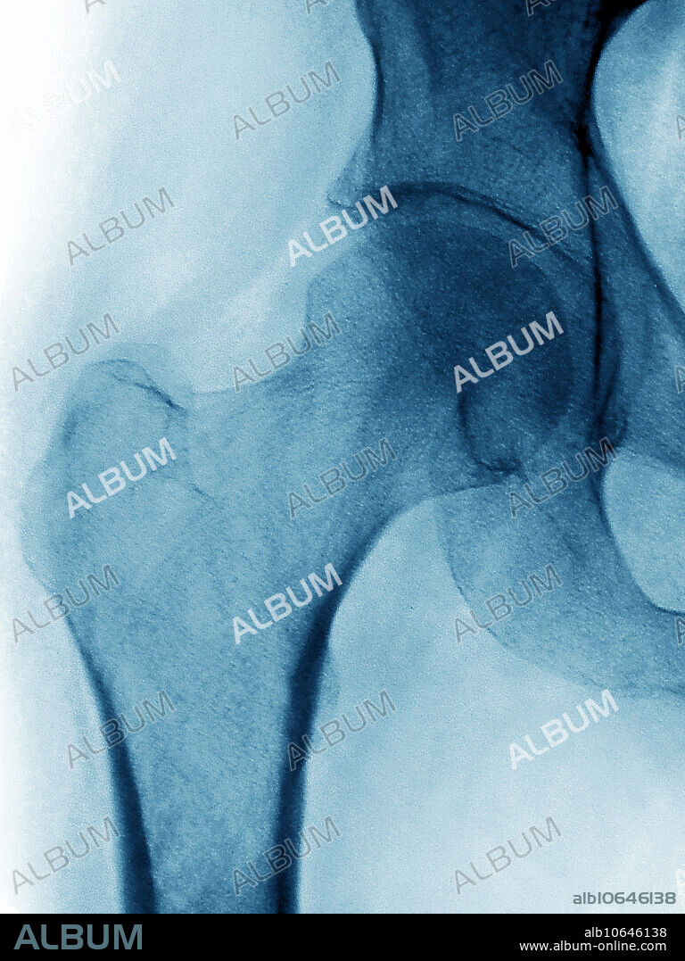 X-ray of a normal right hip.