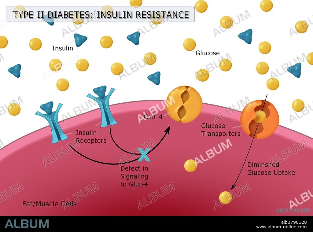 Illustration of insulin and glucose production in Type 2 diabetes. Insulin (blue triangles) is produced by islet cells in the pancreas, and acts in unison with glucose (yellow dots) to regulate energy in the body's cells. In Type 2 Diabetes, as shown here, the body develops high blood glucose levels due to insulin resistance or relative insulin deficiency. Also shown in the diagram are glucose transporters (GLUT-4), and the insulin receptors.