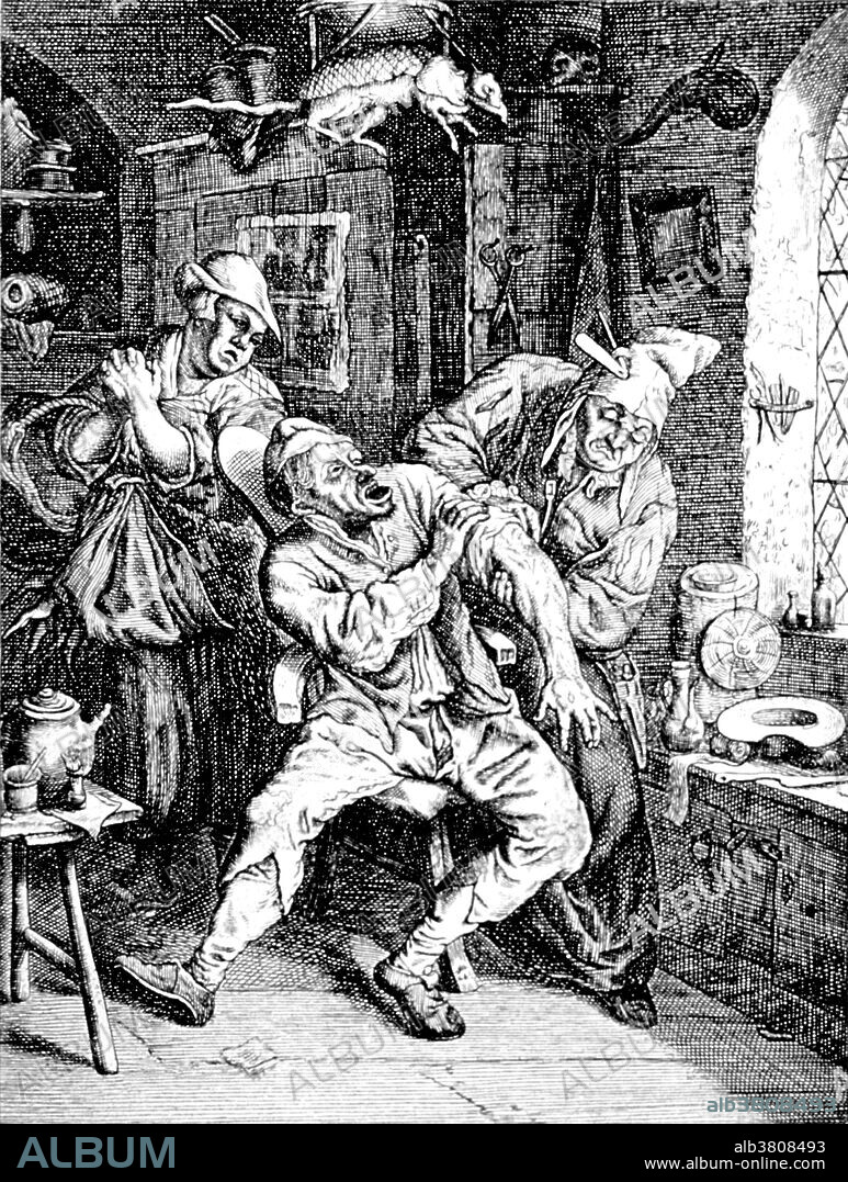 Man, sitting on a chair, is having his arm bandaged by the village physician. A concerned woman waits in the background. In Europe in the 13th century a new type of craftsmen emerged in towns; the barber-surgeon. They cut hair, pulled teeth and performed simple operations such as amputations and setting broken bones and looking after soldiers during or after a battle. Barber-surgeons performed a technique for reconstructing the nose paving the way for the development of modern plastic surgery. The barber surgeon was one of the most common medical practitioners of medieval Europe. In 1745 a bill was passed separating barbers from surgeons. When the barber-surgeons separated, the barber kept the pole as their identification. The pole consists of red and white, or red, white and blue stripes. Red for blood, white for bandages and blue for veins. Engraving by Cornelis Dusart.