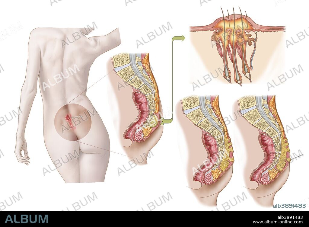 Medical ilustration of a pilonidal cyst near the natal cleft of the buttocks.