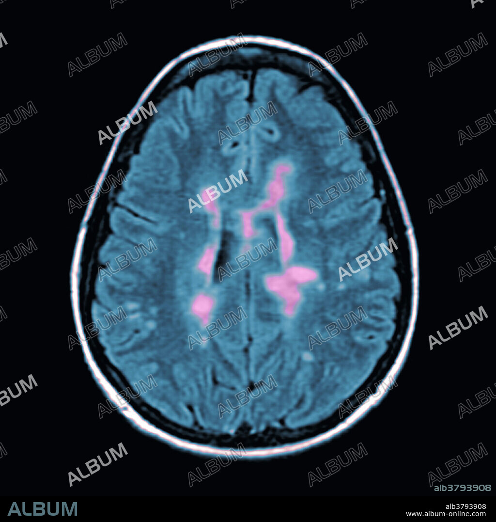 MRI of Multiple Sclerosis