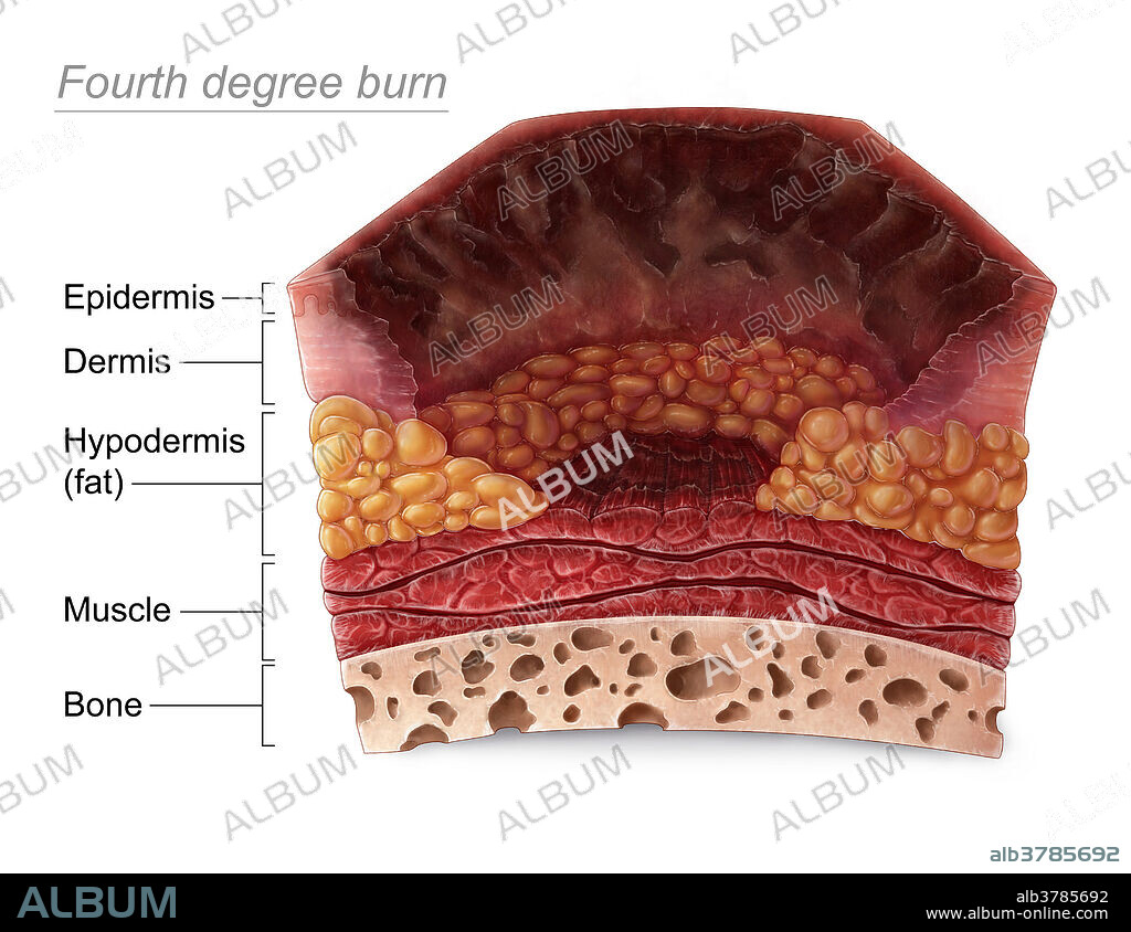 An illustration of a section of skin with a fourth degree burn. Fourth degree burns extend through the entire skin and into the underlying layers of fat, muscle, and even bone. These burns take on a blackened or charred appearance that requires excision or amputation of dead tissue.