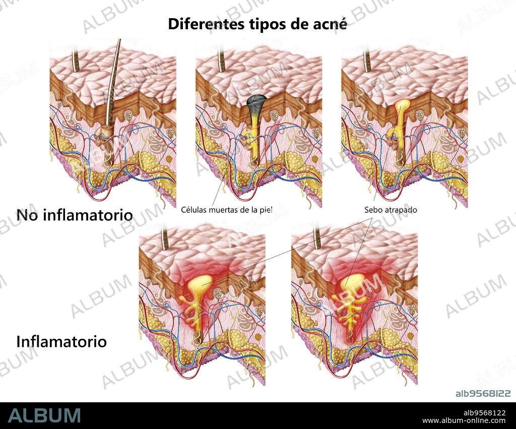 Different types of acne, non-inflammatory and inflammatory.