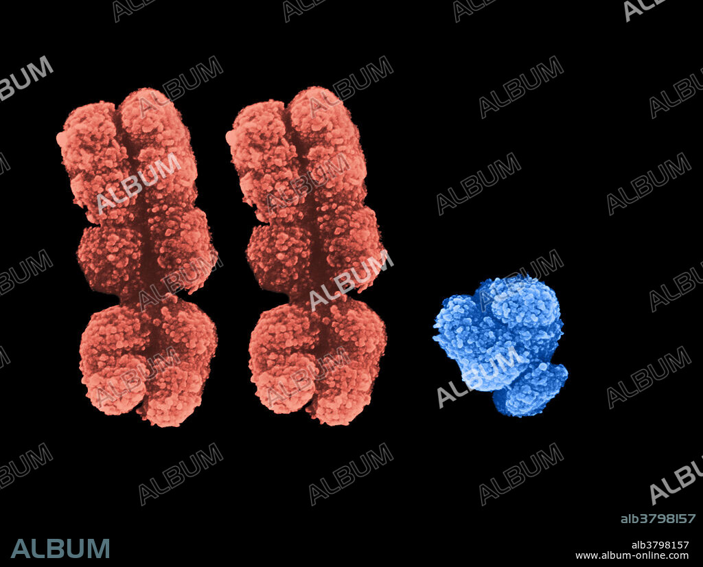 Composite Scanning Electron Micrograph (SEM) of human chromosomes, showing two X and one Y chromosome, as is found in Klinefelter syndrome. This is a genetic disorder in which there is at least one extra X chromosome to a standard human male karyotype. Common effects include reduced fertility, enlargement of the breasts, smaller testes, and reduced facial and body hair. Some individuals also have learning disabilities and/or behavioural problems.
