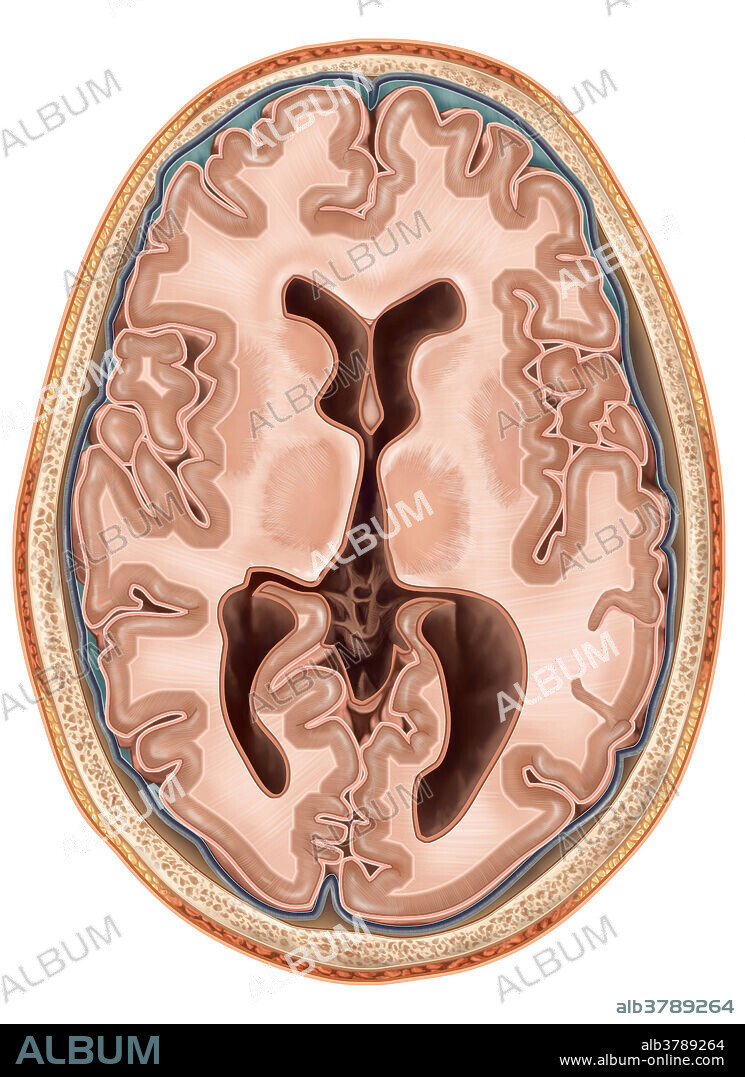 An illustrated transverse view of the brain. Depicted are the lateral ventricles, hollow cavities which are filled with cerebrospinal fluid that help nourish and support the brain and spinal cord. The telencephalon is divided into cerebral hemispheres within the brain including the cerebral cortex, white matter and the basal ganglia.