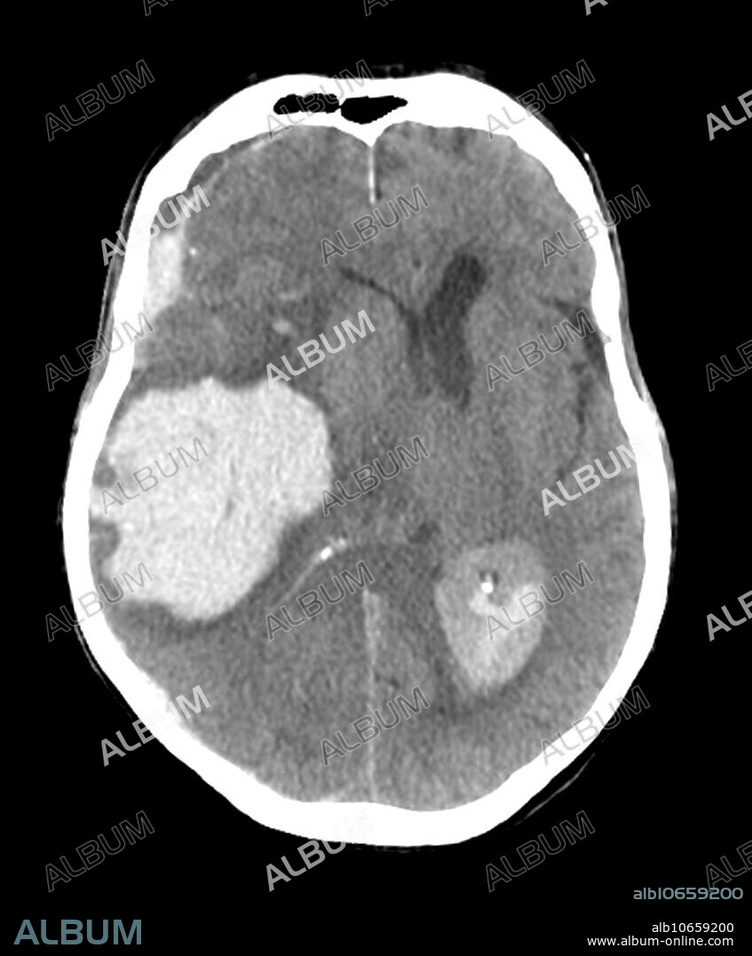 Massive Intracranial Hemorrhage, CT Scan