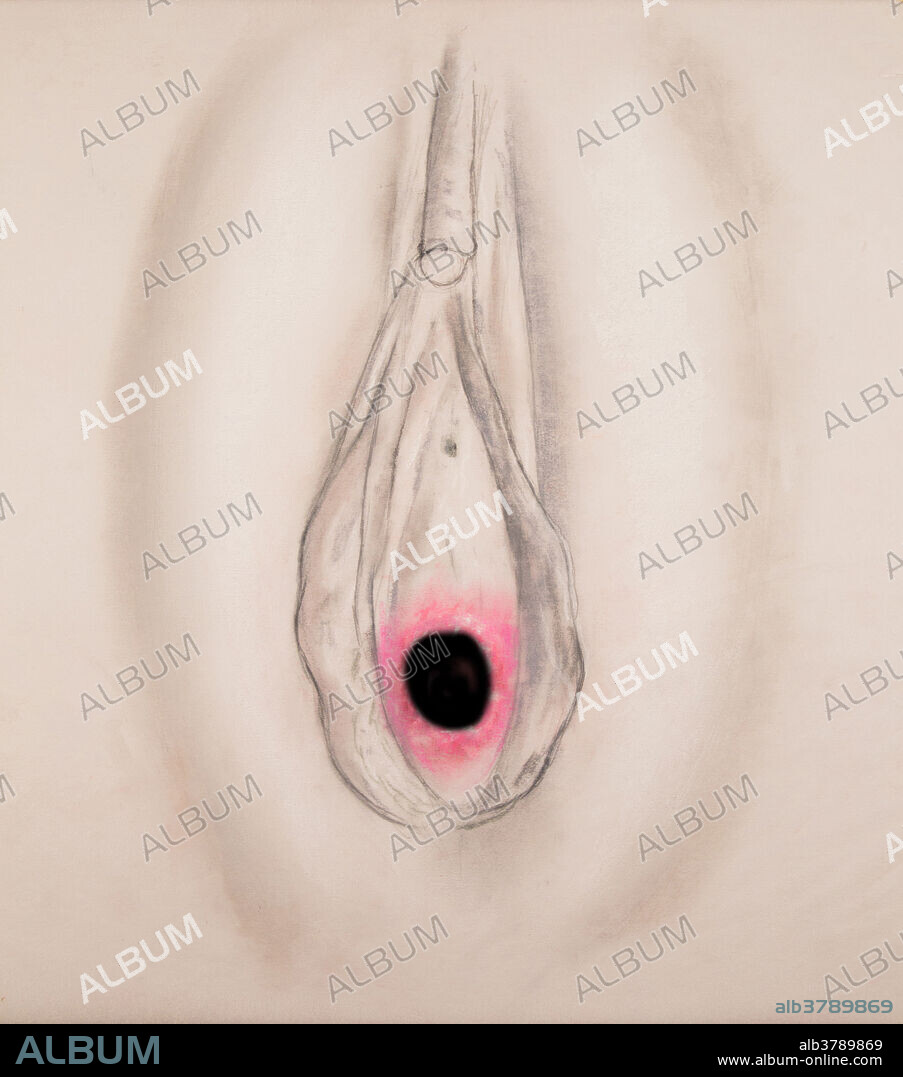 The annular hymen has a nearly circular opening. The hymen is a membrane that partly covers the opening of the vagina. It's strength, elasticity, form and appearance can vary greatly from one individual to another. In most cases it's presence or condition is not a reliable indicator of virginity. Physical exercise, tampon use, medical exams, masturbation, and injuries can all rupture the hymen besides sexual intercourse. In some cases the hymen may be elastic enough to allow sexual intercourse without altering it's appearance. Thus the tradition in many cultures that a bride must bleed on her wedding night to prove her virginity is completely unfounded.