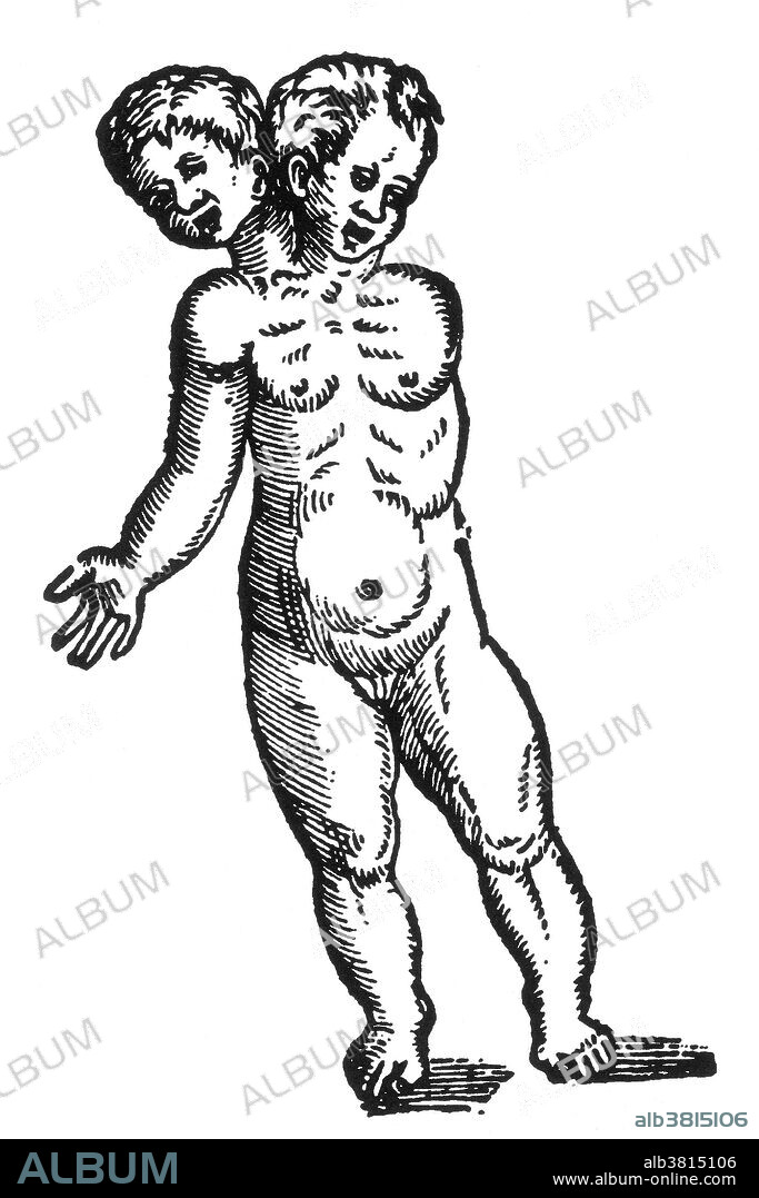 Woodcut of a "monster having two heads, two legs, and only one arm" from Des Monstres et prodiges by Ambroise ParÃ©, 1573. Conjoined twins are identical twins born with their bodies joined at some point and having varying degrees of residual duplication, a result of the incomplete division of the ovum from which the twins developed. Des Monstres is filled with unsubstantiated accounts of sea devils, marine sows, and monstrous animals with human faces. With its extensive discussion of reproduction and illustrations of birth defects, the book invited accusations of pornography.