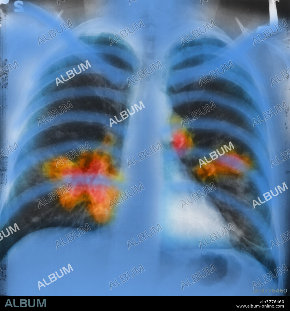 This is an x-ray image of a chest. Both sides of the lungs are visible with a growth on the left side of the lung, which could possibly be lung cancer. Lung cancer, also known as carcinoma of the lung or pulmonary carcinoma, is a malignant lung tumour characterized by uncontrolled cell growth in tissues of the lung. If left untreated, this growth can spread beyond the lung by process of metastasis into nearby tissue or other parts of the body. Most cancers that start in the lung, known as primary lung cancers, are carcinomas that derive from epithelial cells. This image has been colourized.