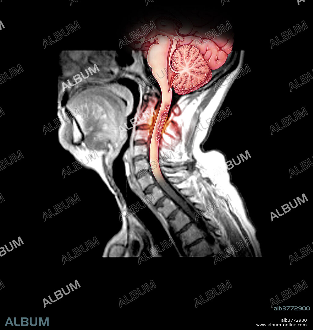 This composite illustration of a MRI of the cervical spine/spinal cord shows an area of pathologic enhancement along the posterior (dorsal) aspect of the upper cervical spinal cord. This is in a patient with multiple sclerosis and represents areas of active demyelination.
