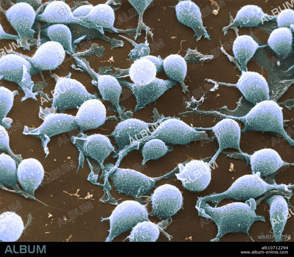 Scanning electron micrograph of human basophils. Basophil is a type of white blood cells. Basophils are the least common of the granulocytes. Basophils contain large cytoplasmic granules which obscure the cell nucleus under the microscope when stained. When unstained, the nucleus is visible and it usually has two lobes. The mast cell, another granulocyte, is similar in appearance and function. Both cell types store histamine, a chemical that is secreted by the cells when stimulated. Magnification @ 1500x, 8x10 print.