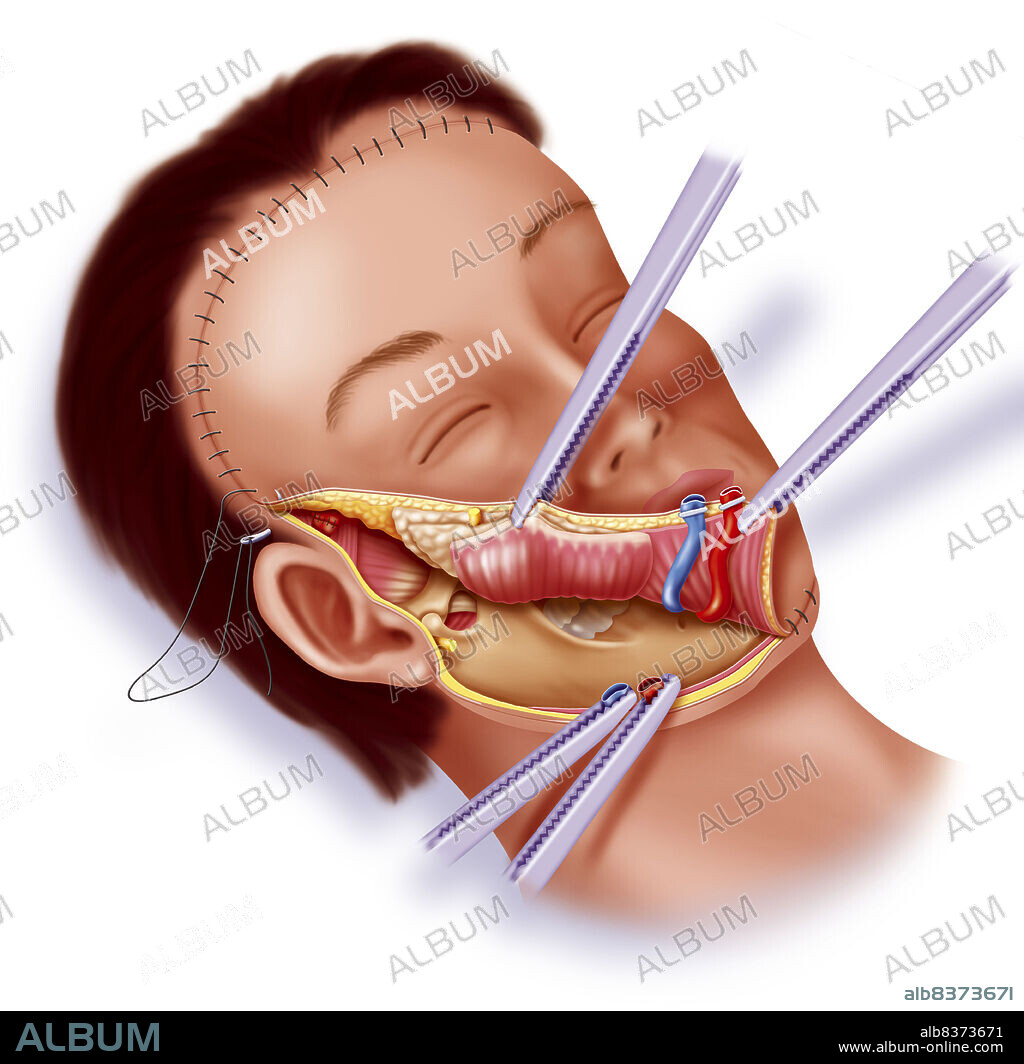Face transplant. Illustration of the transplanting of a new face onto the facial skeleton of a patient. After suturing the nerves and blood vessels, the facial skin surface is sewn on.
