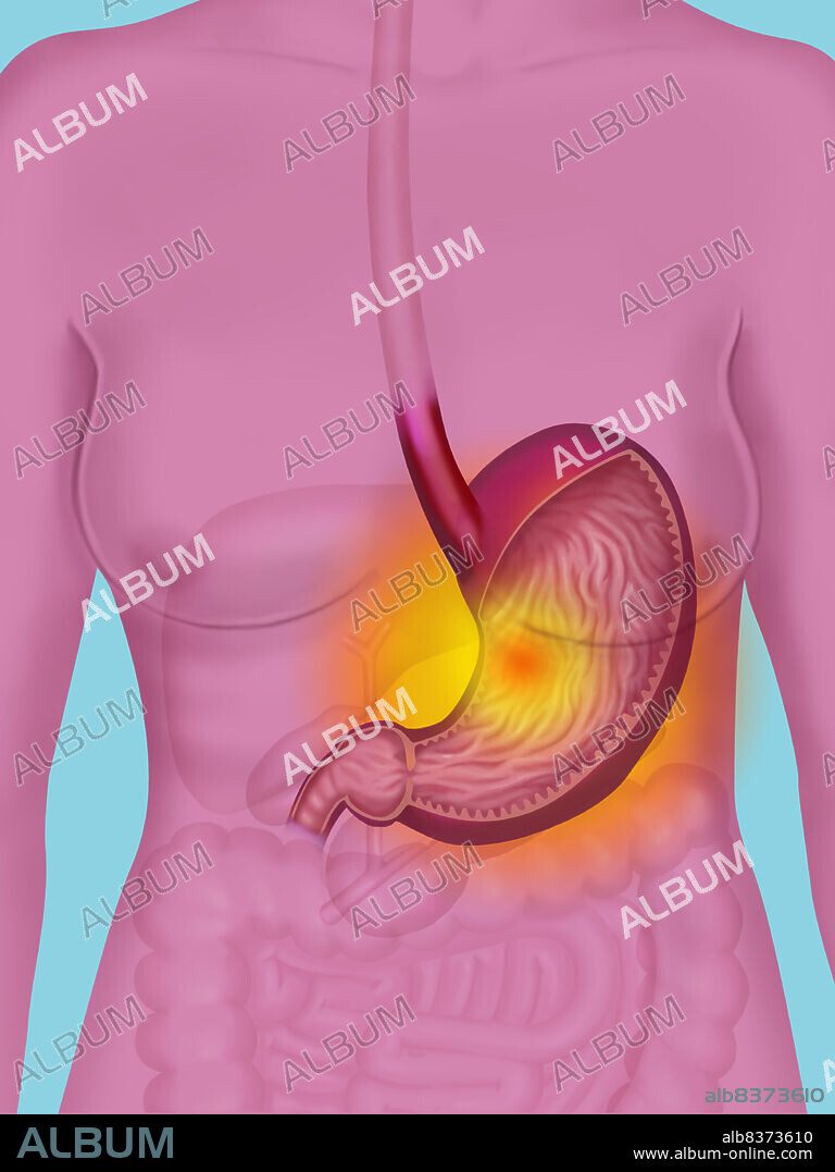 Illustration of stomach disorders : gastric ulcer, gastritis, heartburn.. See images 8509106, 8509206 and 8509306 for similar illustrations.