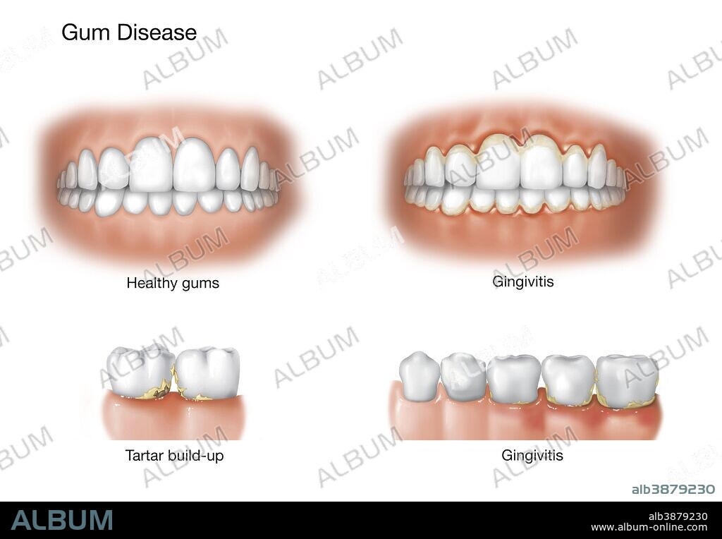 Comparison of healthy gums versus gingivitis.