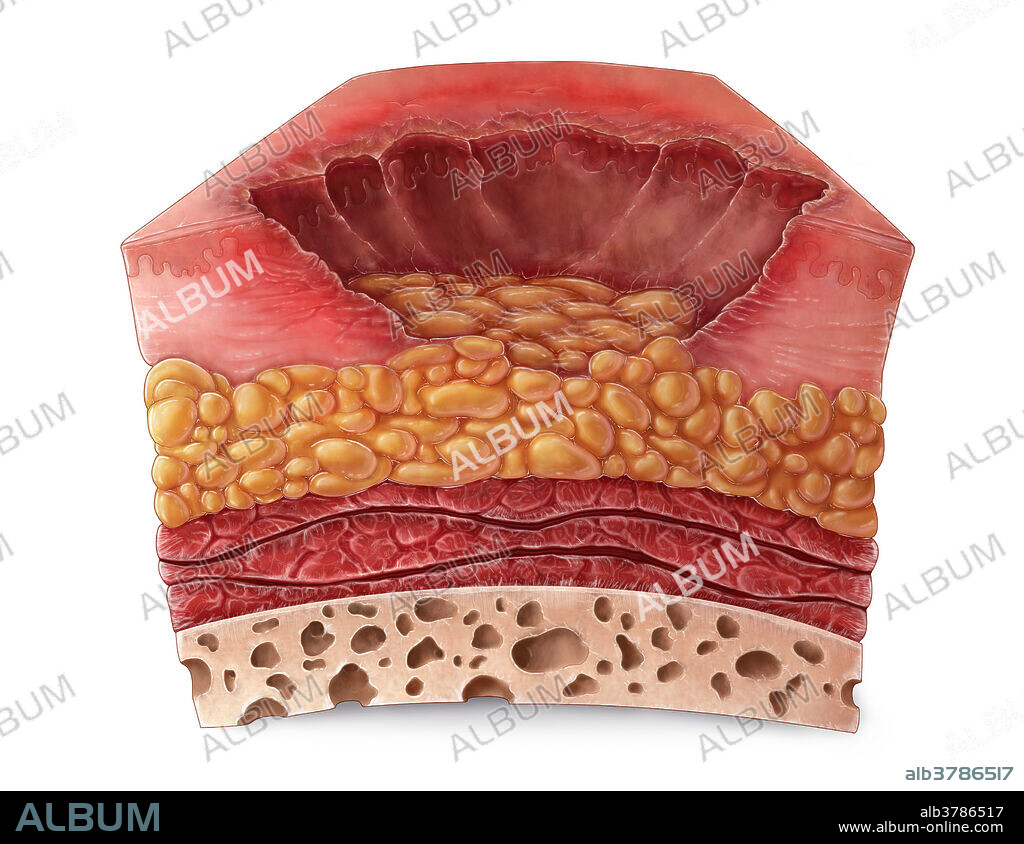 An illustration of a section of skin with a third degree burn. Third degree burns extend through the entire dermis and may take on a white or brown appearance with a leathery texture, often requiring amputation or excision of the affect region.