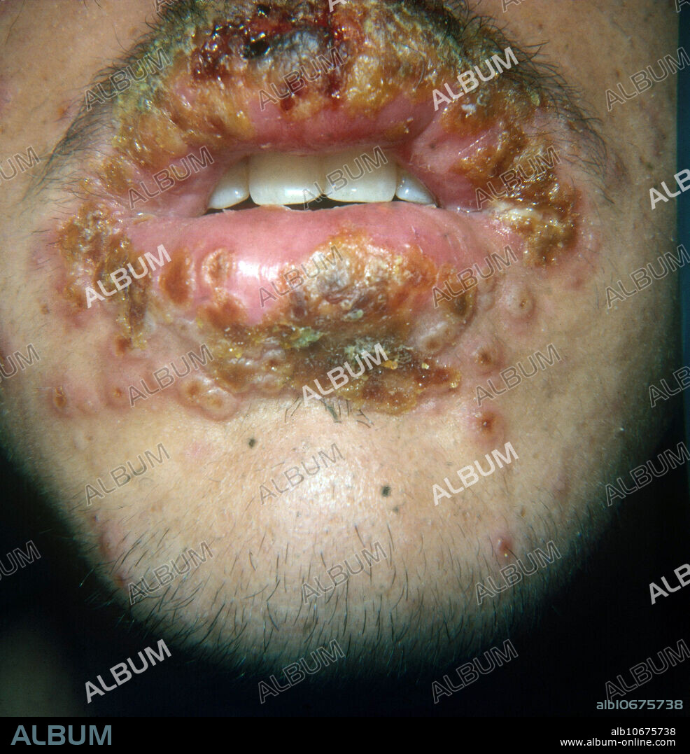 Primary outbreak of herpes simplex around patient's mouth. Herpes vesicles form as a result of necrosis, cell or tissue injury or death, of virus-infected epidermal cells. The infection is contagious and spread by direct contact with the blisters or their fluid. There are two types of herpes simplex virus; HSV1, which causes infections of the nose, mouth and face, and HSV2, which infects the genitals. There is no cure for herpes simplex infection, but outbreaks can be treated with the antiviral drug acyclovir.