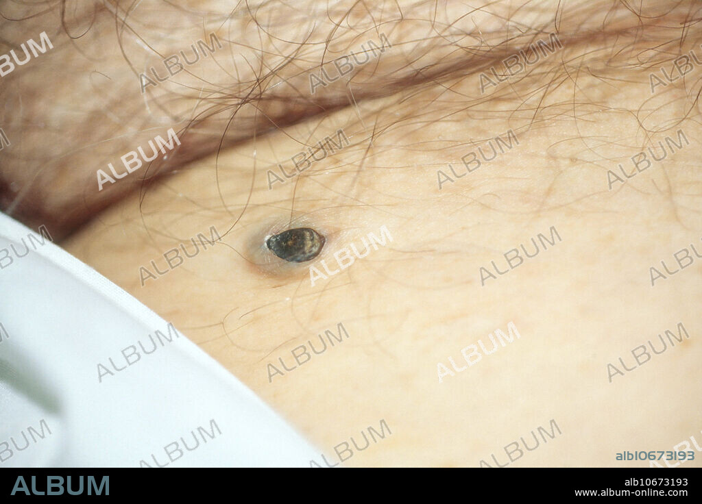 Inguinal dilated pore of Winer, a solitary enlarged comedo (blackhead).