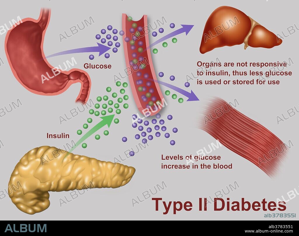 llustration of insulin and glucose production in Type 2 diabetes. Insulin is produced by islet cells in the pancreas, and acts in unison with glucose to regulate energy in the body's cells. In Type 2 Diabetes, as shown here, the body develops high blood glucose levels due to insulin resistance or relative insulin deficiency.