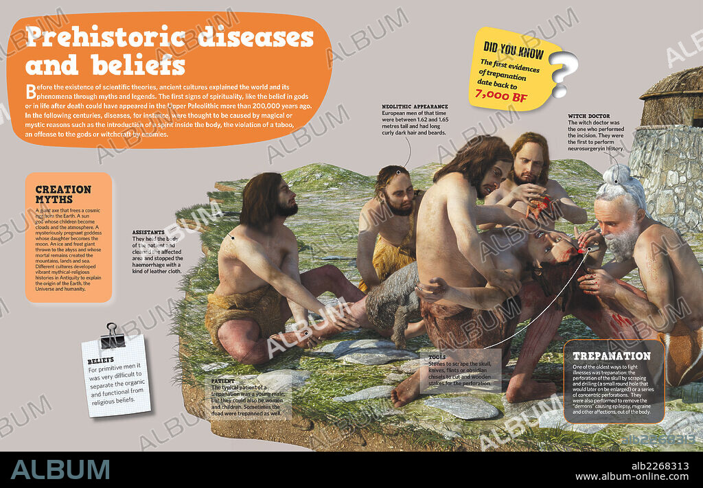 Enfermedades y creencias en la Prehistoria. Infografía sobre cómo, durante la Prehistoria, se realizaba la trepanación, una de las maneras más antiguas de combatir enfermedades.