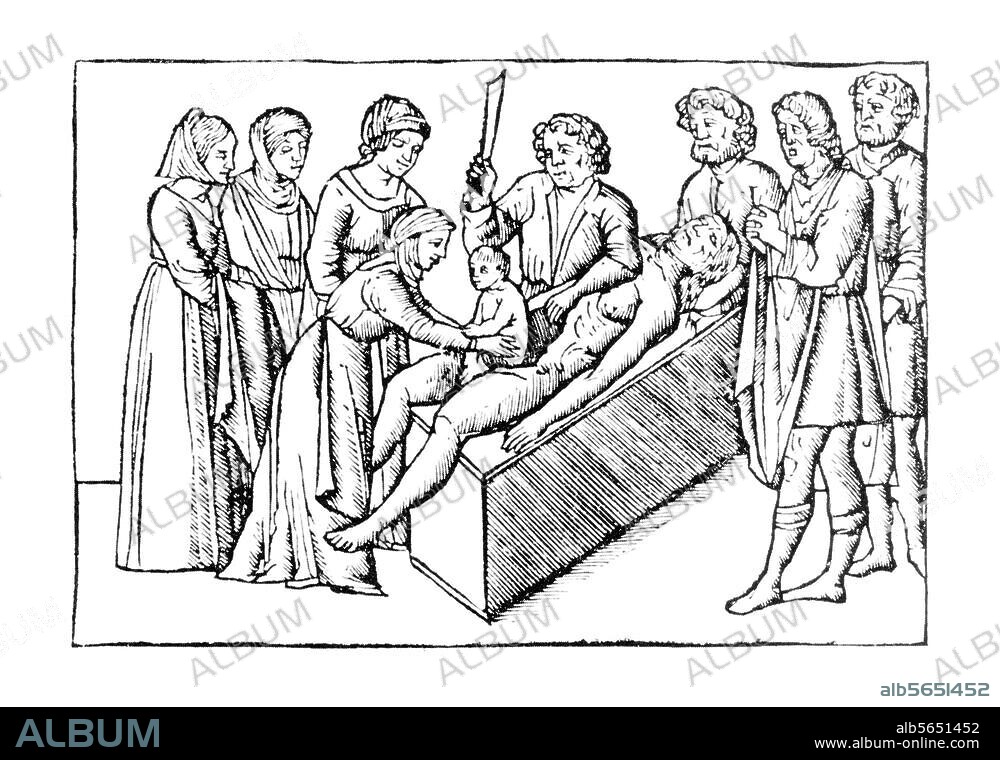 Medizin / Geburt:. Kaiserschnitt. Die Geburt des Gaius Iulius Caesar mittels der sectio caesarea (= Kaiserschnitt). Holzschnitt. Aus: Sueton, Vitae Caesarum, ed. Venedig (J.Rubeus) 1506.