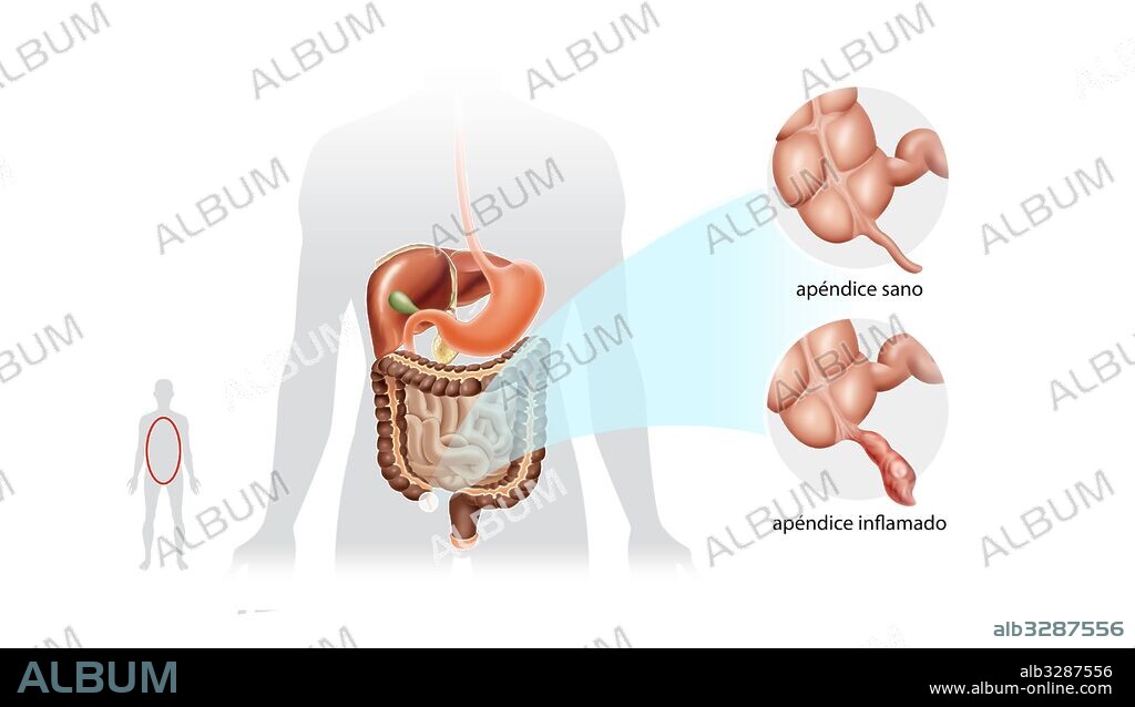 Apendicitis.