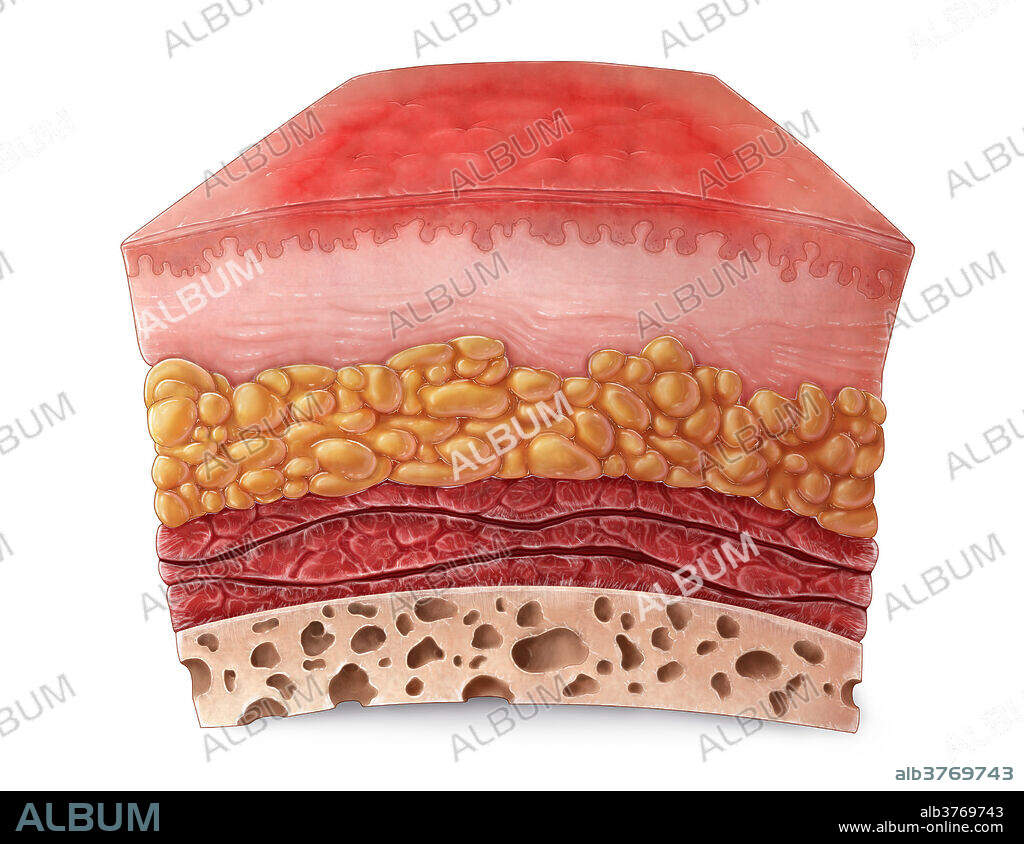 An illustration of a section of skin with a first degree burn. First degree burns only affect the superficial layer of skin, known as the epidermis, and has a dry red appearance. Sunburns are the most common cause of first degree burns and can be painful for the first two or three days. These burns typically heal quickly (between 1-2 weeks), but may increase a patient's risk for skin cancer later in life.