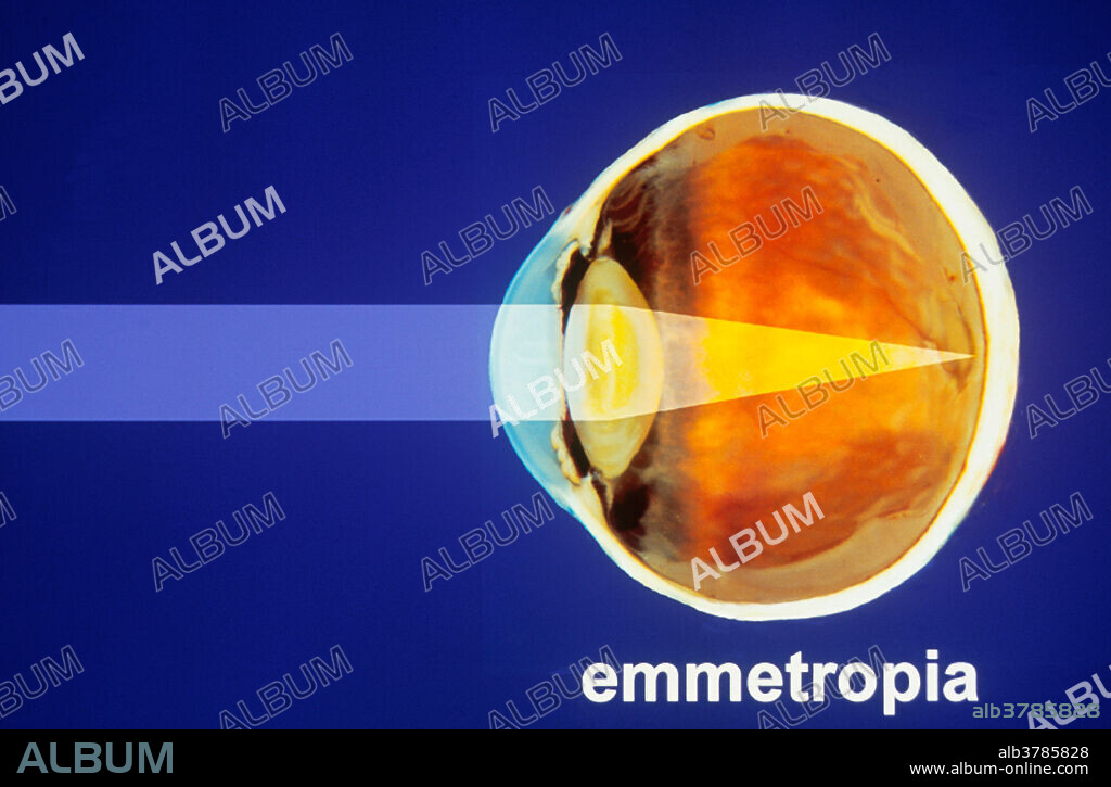 Diagram showing emmetropia, the normal state of vision in which the eye lens is neutral and objects more than twenty feet away are sharply in focus.