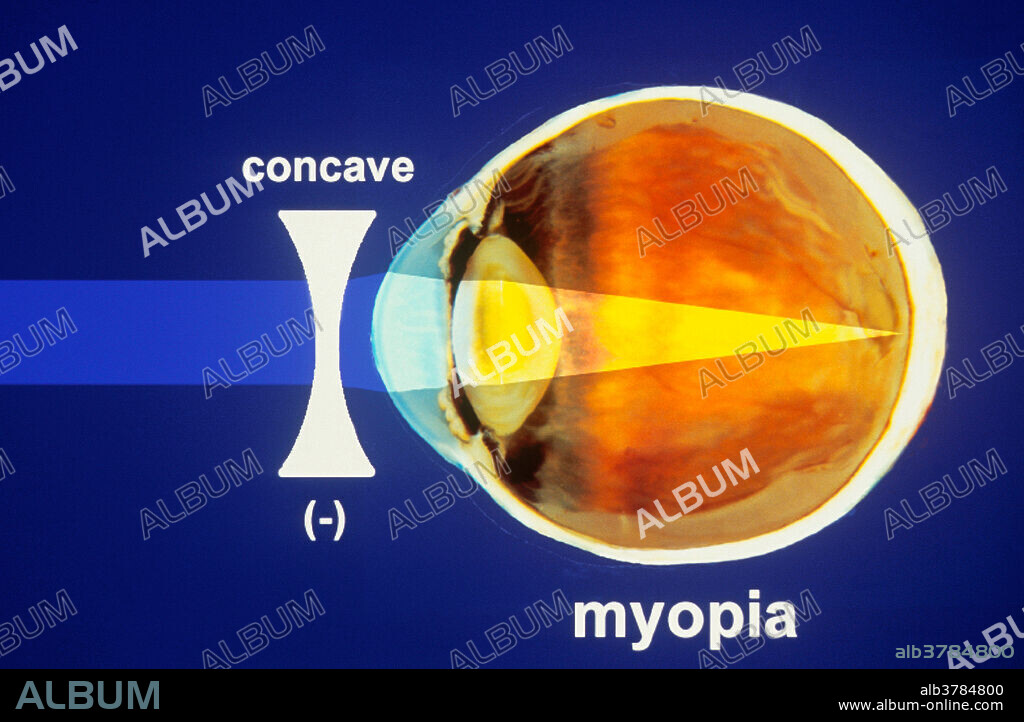 Diagram showing the correction of myopia with the use of a concave lens. Myopia is a defect of the eyes in which the eyeball is too long, or the cornea overly curved. This leads to images being focused in front of the retina, instead of on it. Nearsightedness, or the blurring of objects at a distance, results.