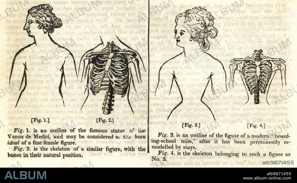 Comparison of female outline and skeleton after permanent disfigurement from whale-bone corsets from Professor Sommering's On The Effects of Stays. Woodblock engraving from The Penny Magazine, of the Society for the Diffusion of Useful Knowledge, printed by William Clowes, Lambeth, 1833.
