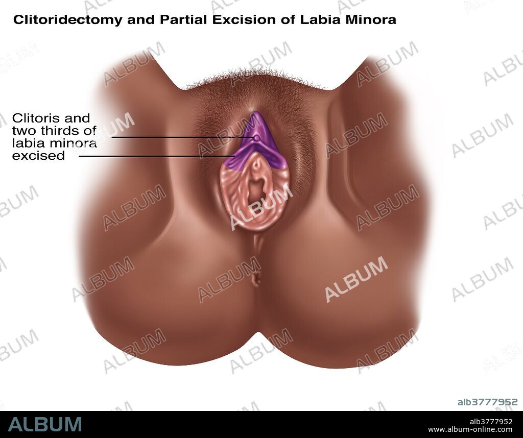 Illustration of a clitoridectomy and partial excision of the labia minora (two thirds excised). One of various methods of ritual removal of some or all of the female genitalia. These procedures are performed by a traditional circumciser using a blade or razor, with or without anesthesia. Female genital mutilation has been outlawed or restricted in most of the countries in which it occurs. It is rarely done as a therapeutic medical procedure, such as when cancer has developed in or spread to the clitoris.