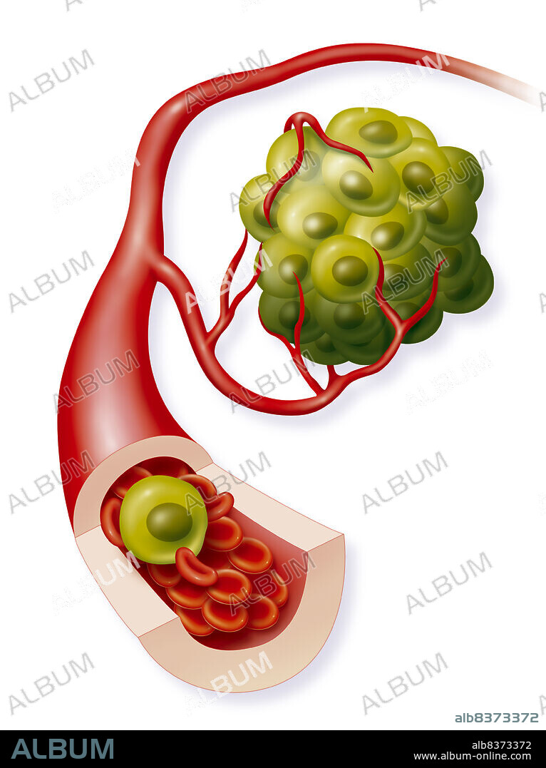 Illustration of a cancer tumour and its developed arterial network. Cancer cells detach themselves from the tumour and end up in the bloodstream. Large cancer cells are detected during the blood test to screen for cancer.