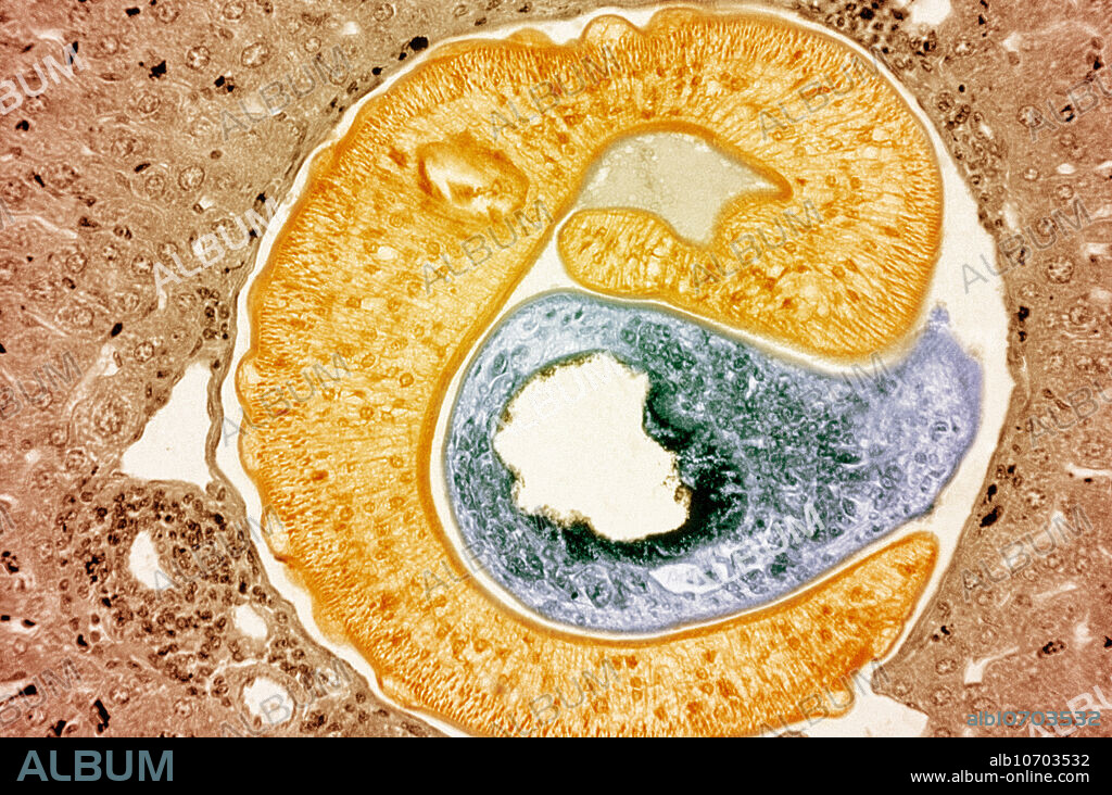 Micrograph of a human liver section showing the parasite Schistosoma mansoni (fluke). This is the major agent of schistosomiasis, a parasitic disease that infects humans.
