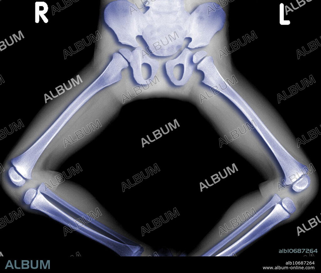 colour-enhanced x-ray showing the hips, pelvis, and legs in a frog position.