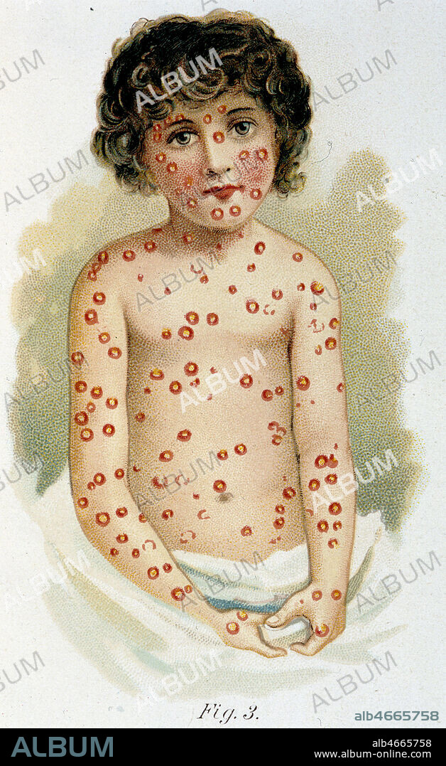 Enfant atteint de variole. 'Petite verole volante, varicelle pustuleuse'. Chromolithographie, planche XVIII du Livre d'or de la Sante, publie en 1910 par PLATEN. Credit : Collection Grob/KHARBINE-TAPABOR.