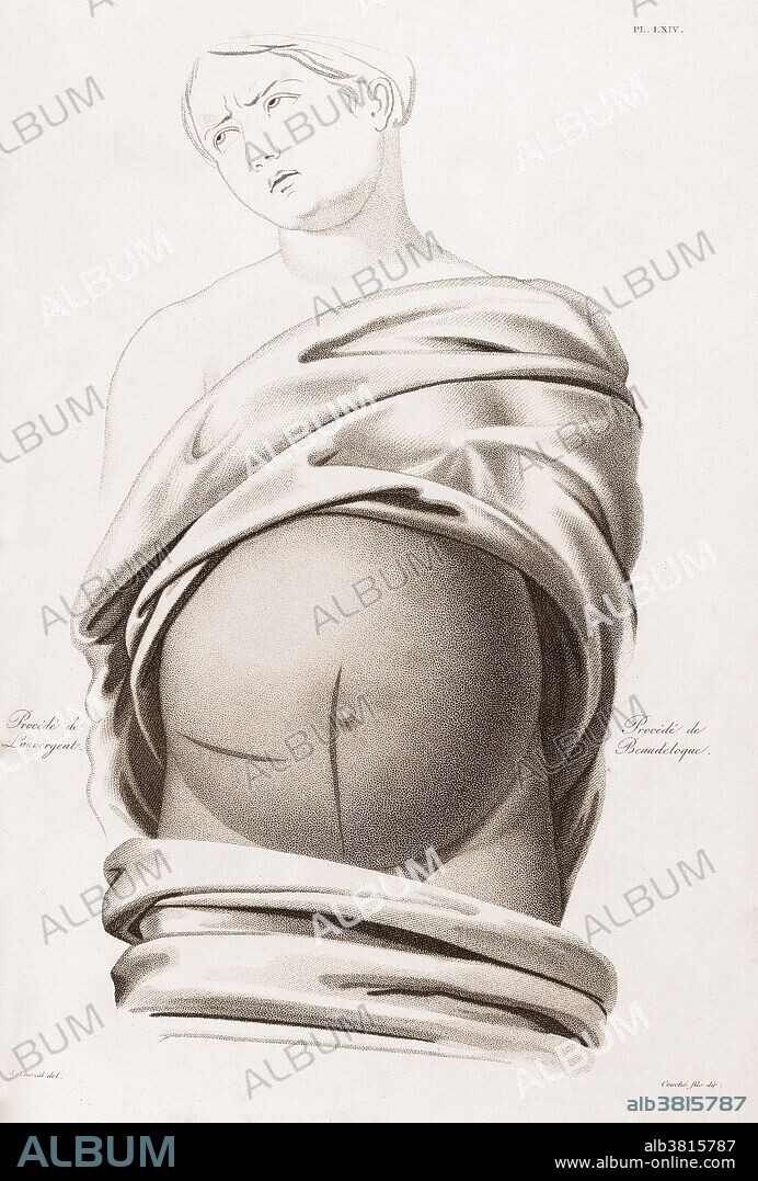 Diagram showing two different incisions, the longitudinal procedure introduced by Beaudeloque and the transverse procedure introduced by Lauvergeat, used in early Cesarean operations. Illustration by Jacques-Pierre Maygrier, 1822.